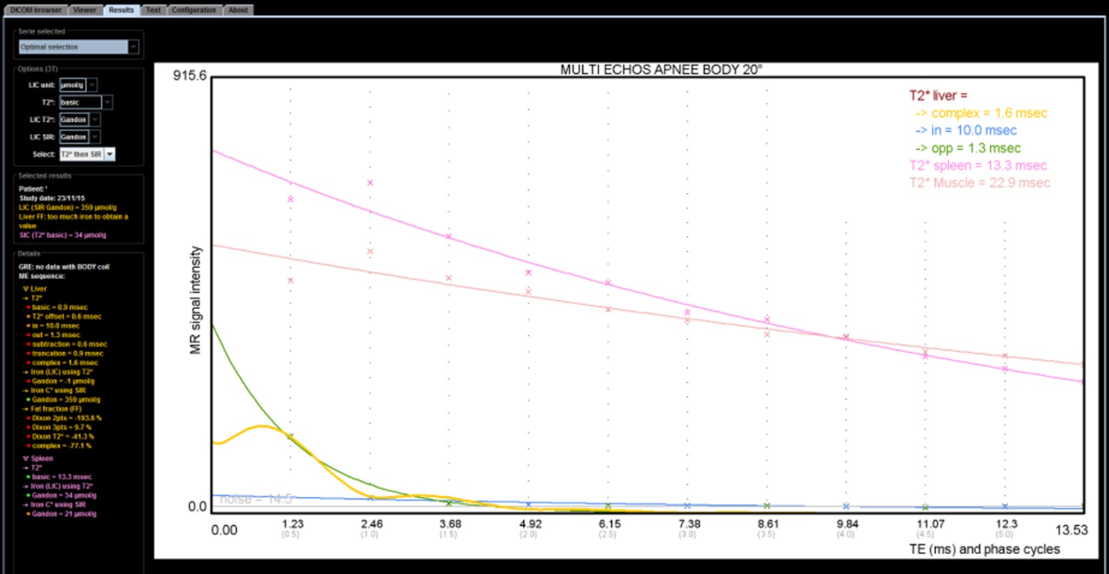 MRQuantif curves when 3T VIBE dixon map error